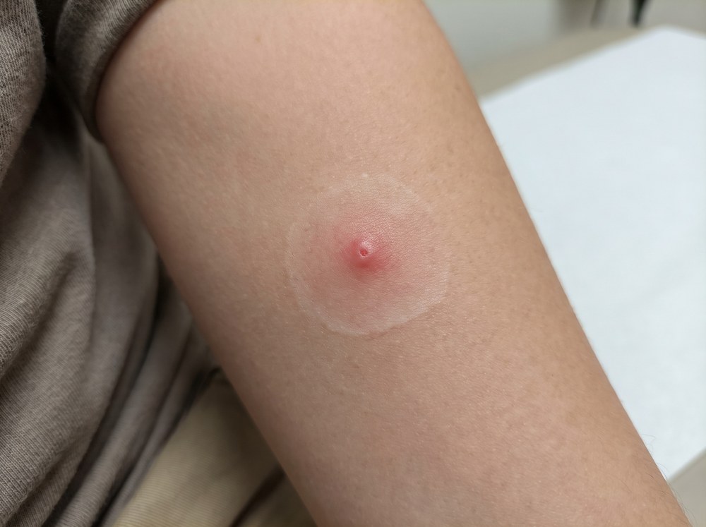 Close-up of a mild red bite mark on human skin from a spinybacked orbweaver, showing slight swelling similar to a small bee sting welt