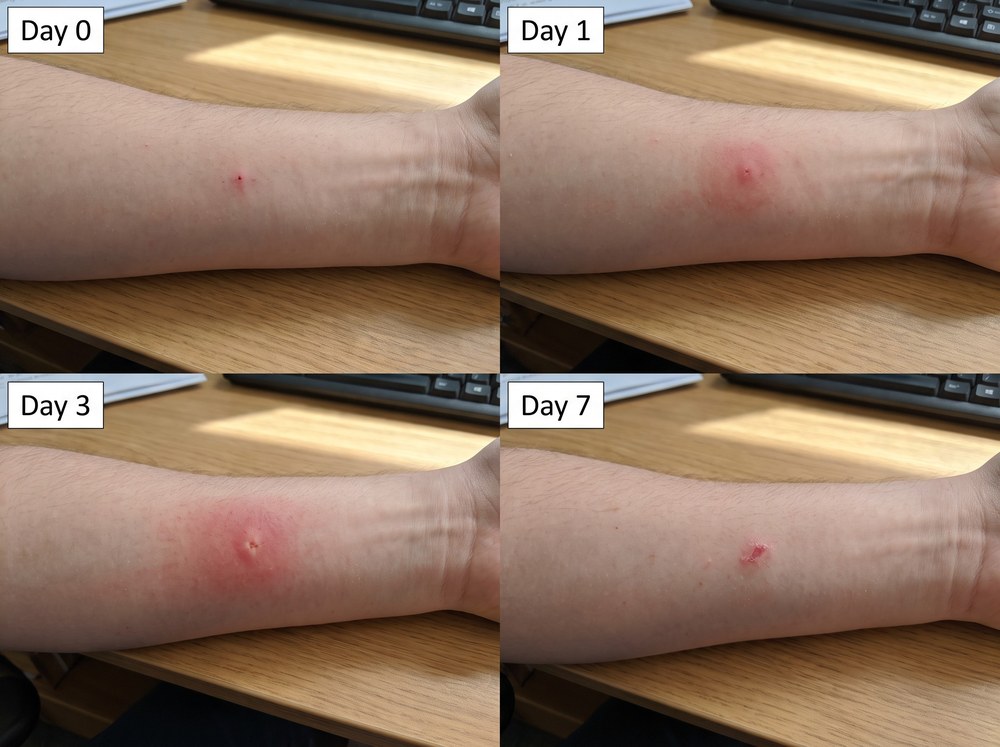 Four-panel progression photo showing a mild spinybacked orbweaver bite mark fading from day zero through day seven of healing